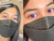 ฮือฮาสาวติดโควิด กินยาฟาวิพิราเวียร์ ตากลายเป็นสีม่วง นึกว่าใส่ฟิลเตอร์ แพทย์เผยสาเหตุ