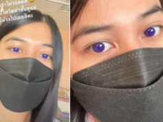 ฮือฮาสาวติดโควิด กินยาฟาวิพิราเวียร์ ตากลายเป็นสีม่วง นึกว่าใส่ฟิลเตอร์ แพทย์เผยสาเหตุ