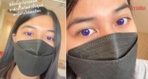 ฮือฮาสาวติดโควิด กินยาฟาวิพิราเวียร์ ตากลายเป็นสีม่วง นึกว่าใส่ฟิลเตอร์ แพทย์เผยสาเหตุ
