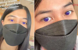 ฮือฮาสาวติดโควิด กินยาฟาวิพิราเวียร์ ตากลายเป็นสีม่วง นึกว่าใส่ฟิลเตอร์ แพทย์เผยสาเหตุ
