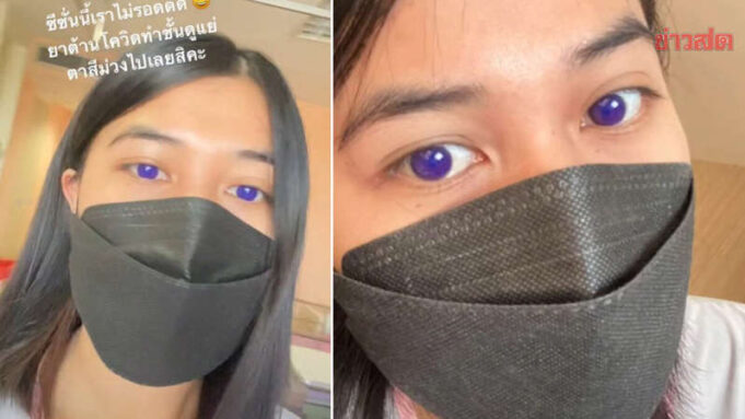 ฮือฮาสาวติดโควิด กินยาฟาวิพิราเวียร์ ตากลายเป็นสีม่วง นึกว่าใส่ฟิลเตอร์ แพทย์เผยสาเหตุ